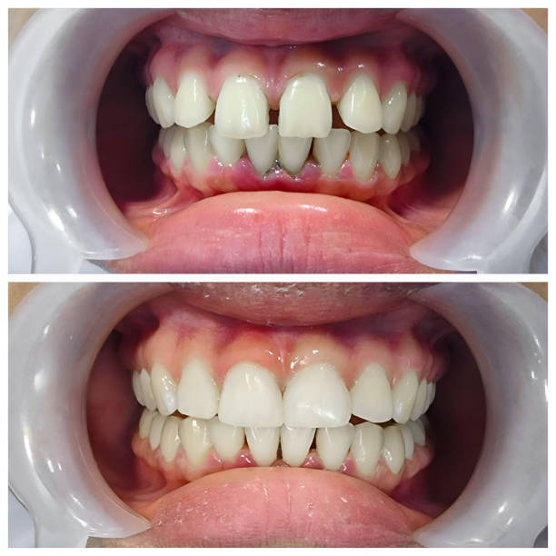 TMJ/TMD Treatment in Terrell Hills, TX